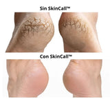 SkinCall™ - Limador Anti Callos Inoxidable - Globo Mercado